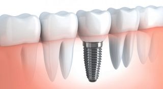 igienista dentale bari Centro Dentistico Tomasicchio prof. Vito A. e dott. Paolo M: