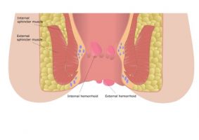 SINTOMI DELLE EMORROIDI