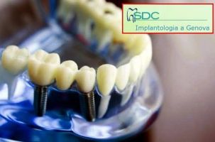 Implantologia Genova Studio dentistico dentista genova centro urgenza dentistica