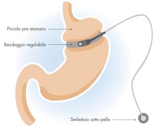 chirurgo bariatrico napoli Dott. Triscino Chirurgo Bariatrico Napoli