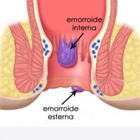 proctologo palermo Emorroidi Senza Dolore Palermo